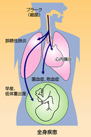 歯周病