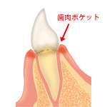 歯周病の進行